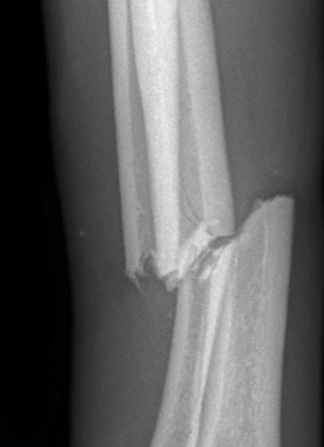Radiographie de profil de l'avant-bras&nbsp;: le radius et l'ulna sont fracturés et décalés, avec des extrémités osseuses irrégulières et pointues